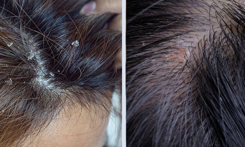 Can seborrheic dermatitis cause hair loss?