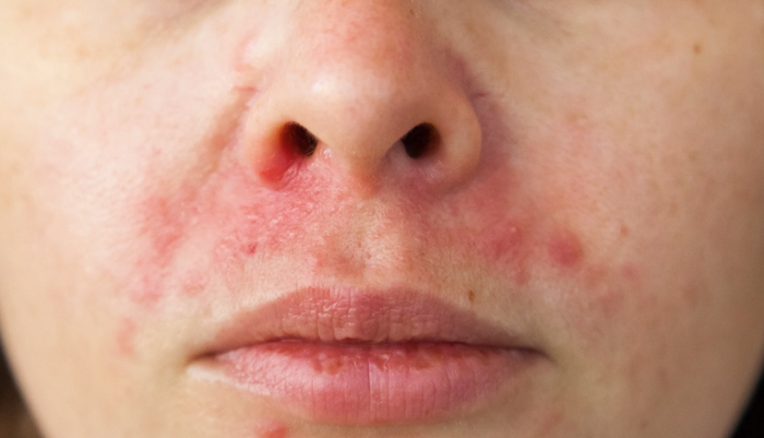 You treat it — and it comes back.